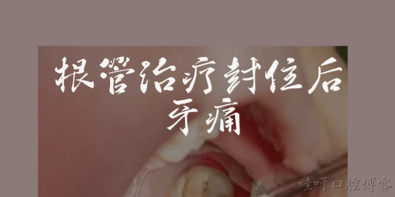 Tooth pain after root canal sealing