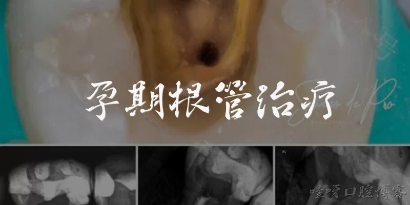 孕期根管治疗