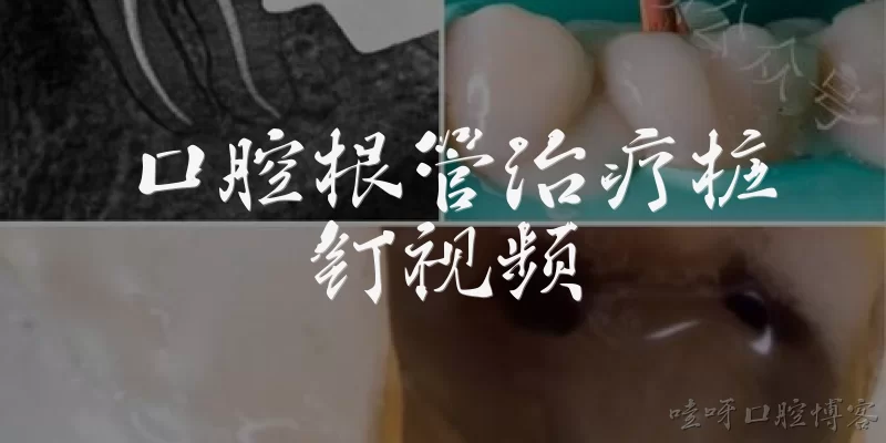 Dental Root Canal Post Video