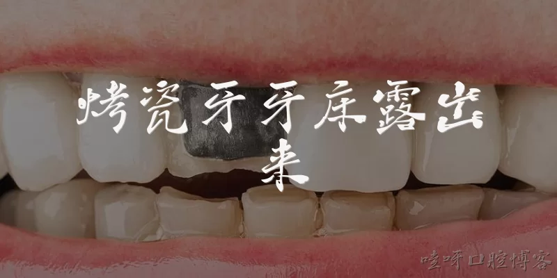 烤瓷牙牙床露出来:烤瓷牙牙床露出来是什么原因导致的？