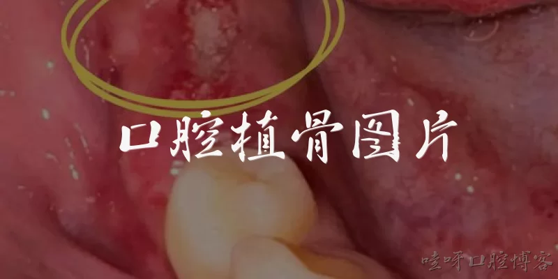 口腔植骨图片