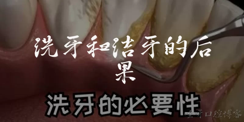 Consequences of Teeth Cleaning and Scaling