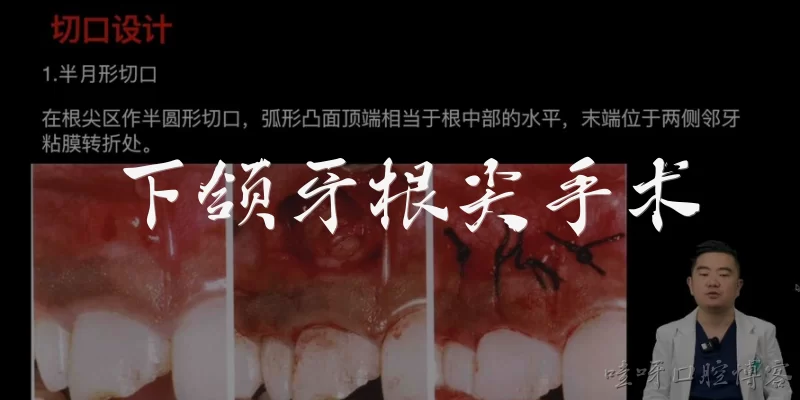 下颌牙根尖手术