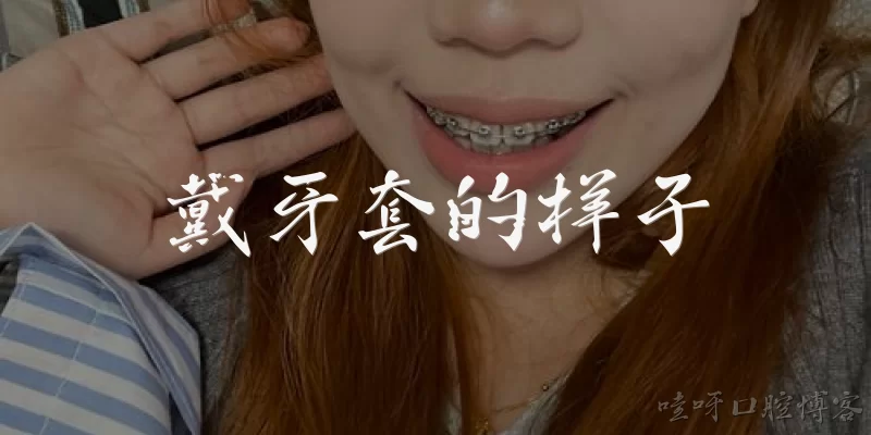 戴牙套的样子