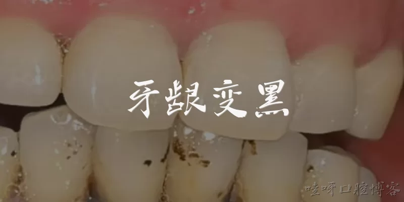 牙龈变黑