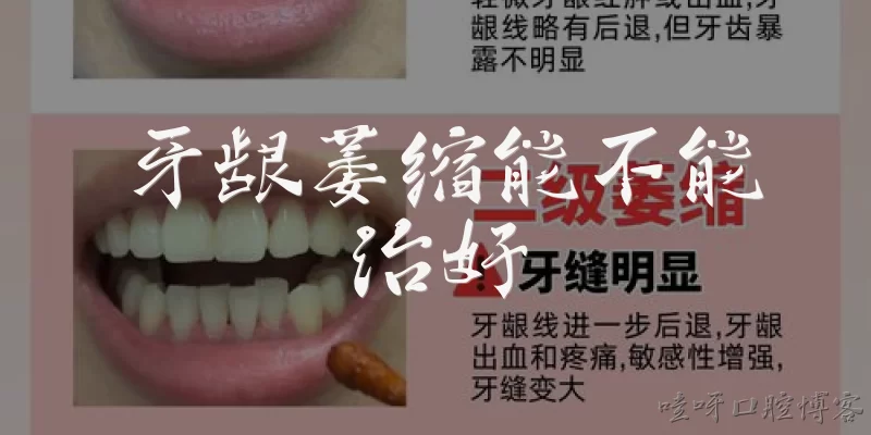牙龈萎缩能不能治好
