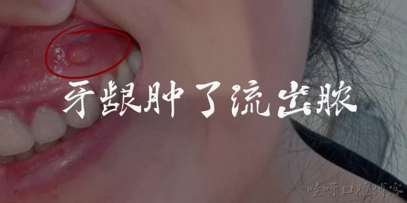 牙龈肿了流出脓