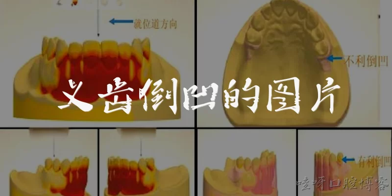 Image of denture undercut