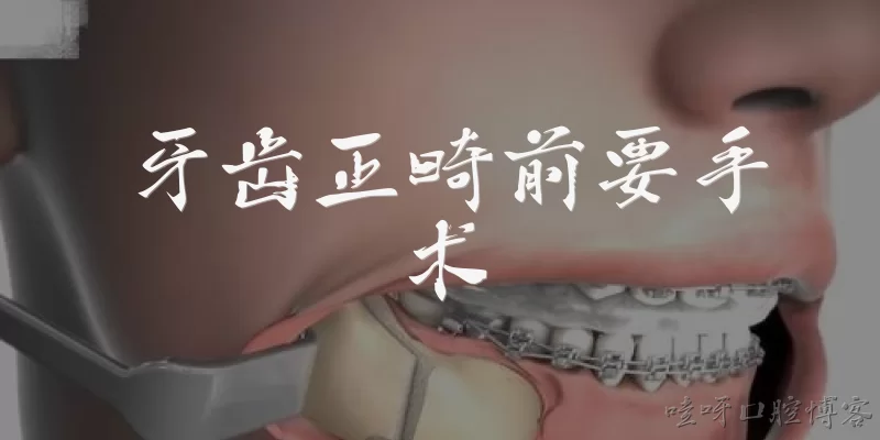 Surgery is required before orthodontic treatment