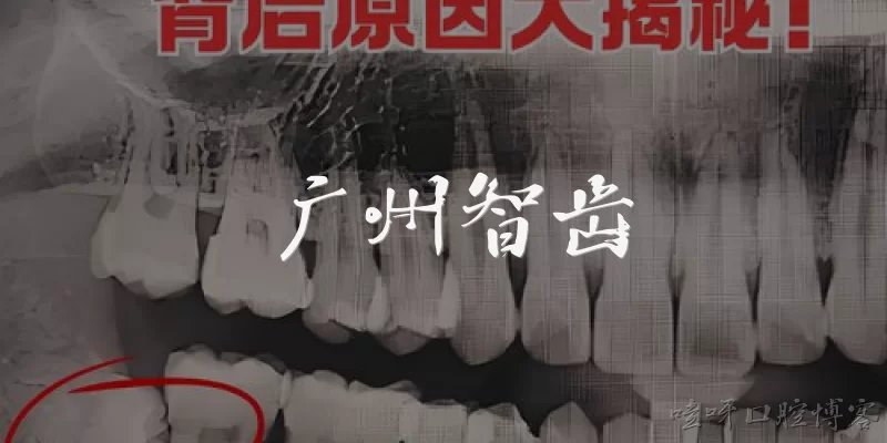 广州智齿:2026年广州拔智齿的费用大概是多少？医保能报销吗？
