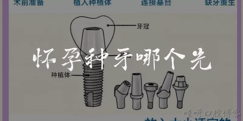 Which comes first: pregnancy or dental implants?